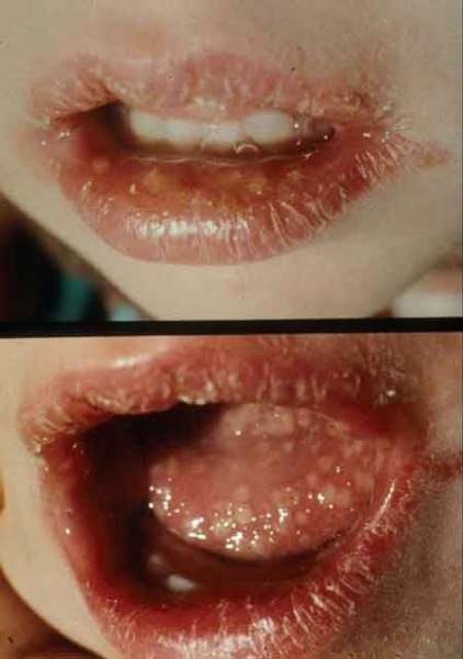 Herpes On Face Cheek Pictures Photos