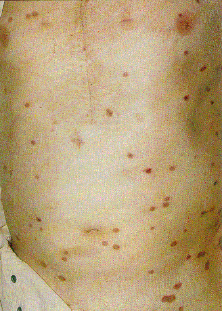 Gonorrhea Symptoms Skin Radmain