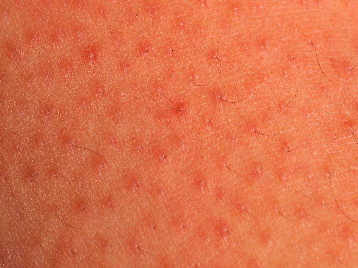 Keratosis Pilaris Forearms