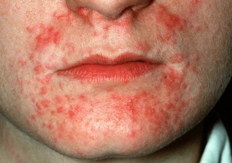 Dermatitis Herpetiformis Treatments Pictures Photos The Best Porn Website