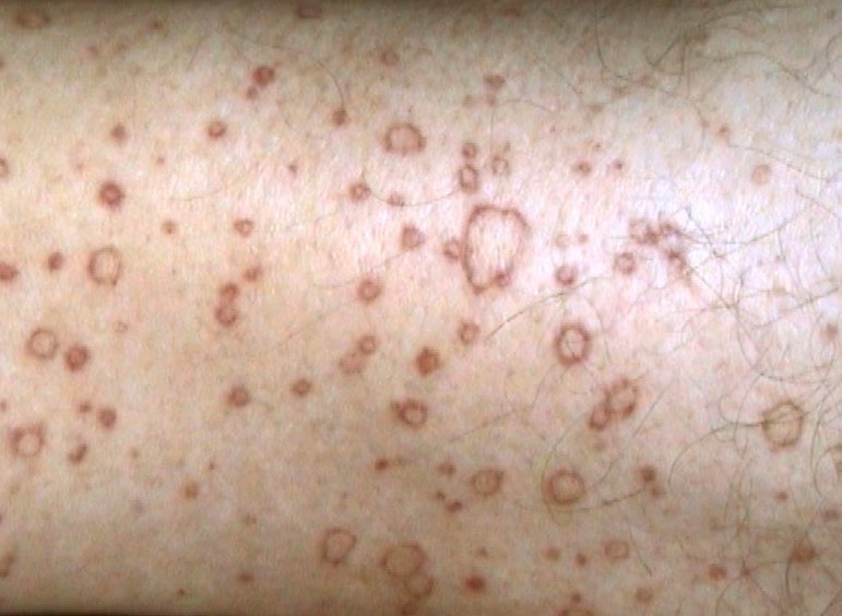 Porokeratosis Treatments Pictures Photos