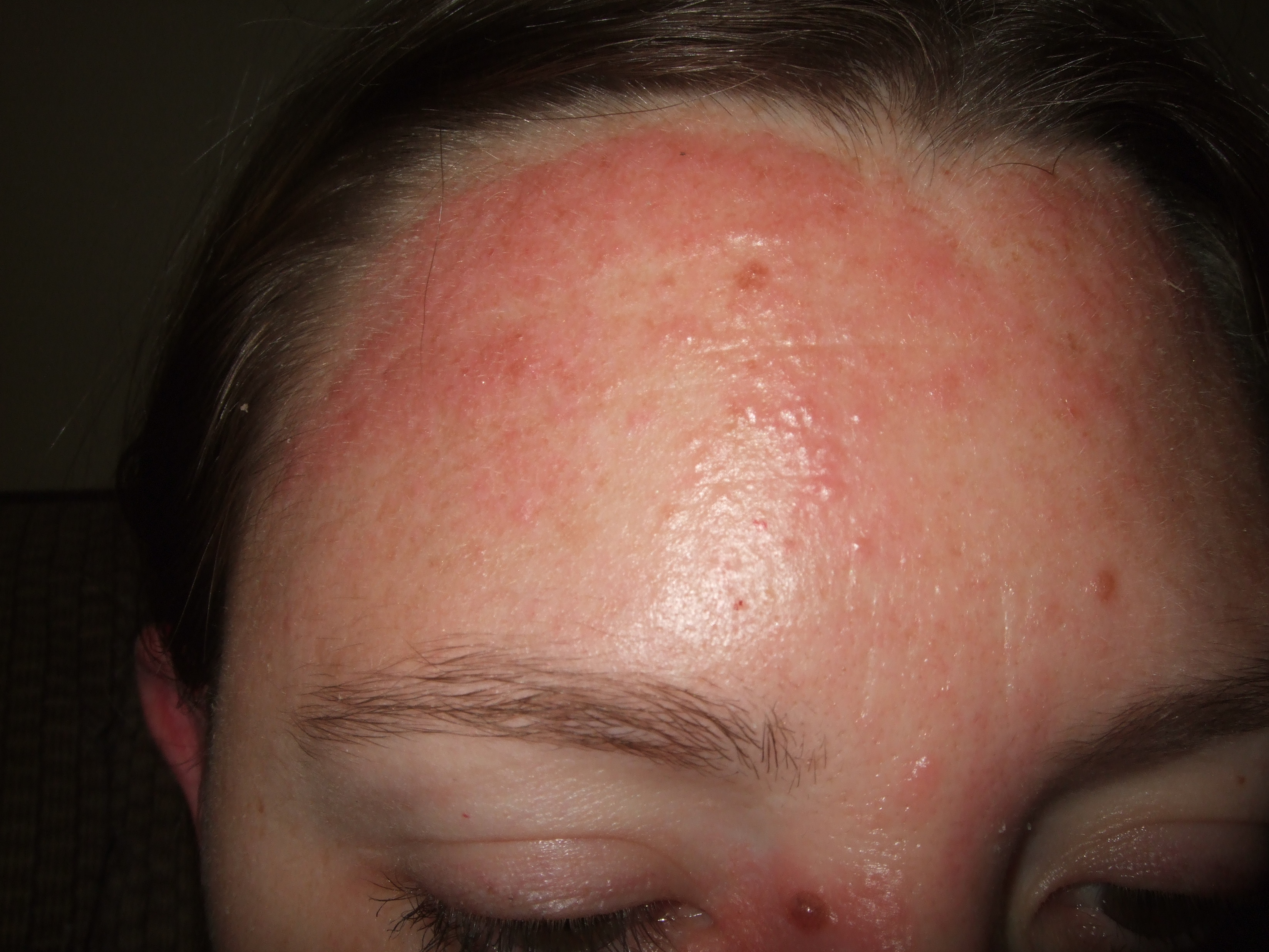 Forehead Rash Pictures Photos