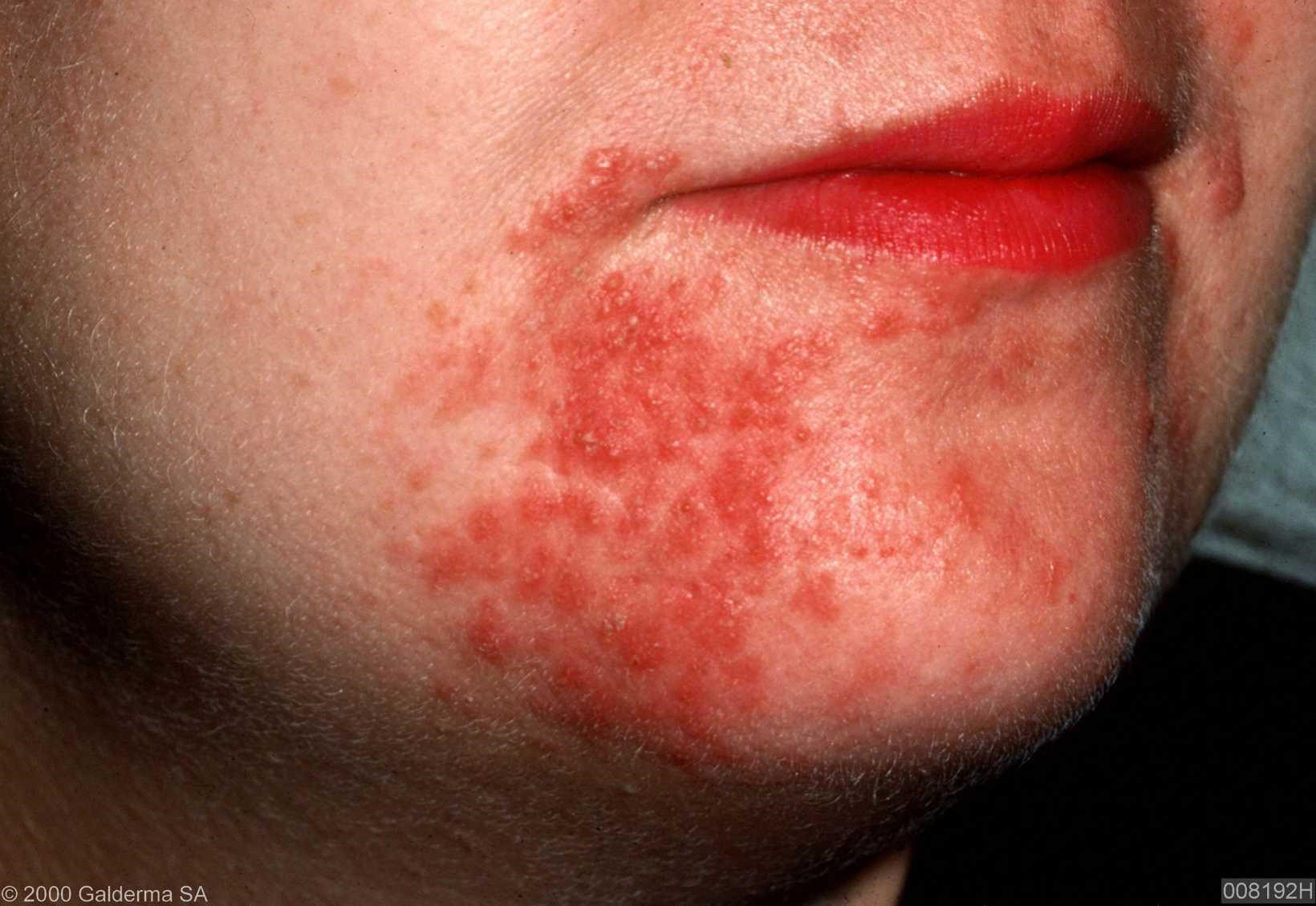 Rashes In The Mouth Pictures Photos