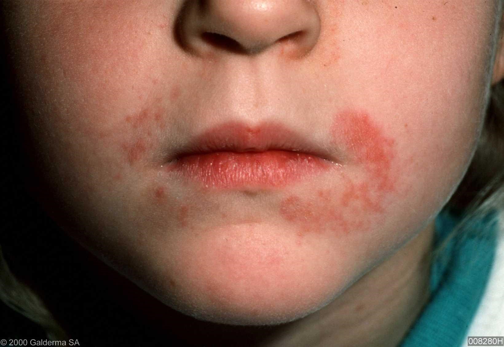 Dermatitis Rash On Face