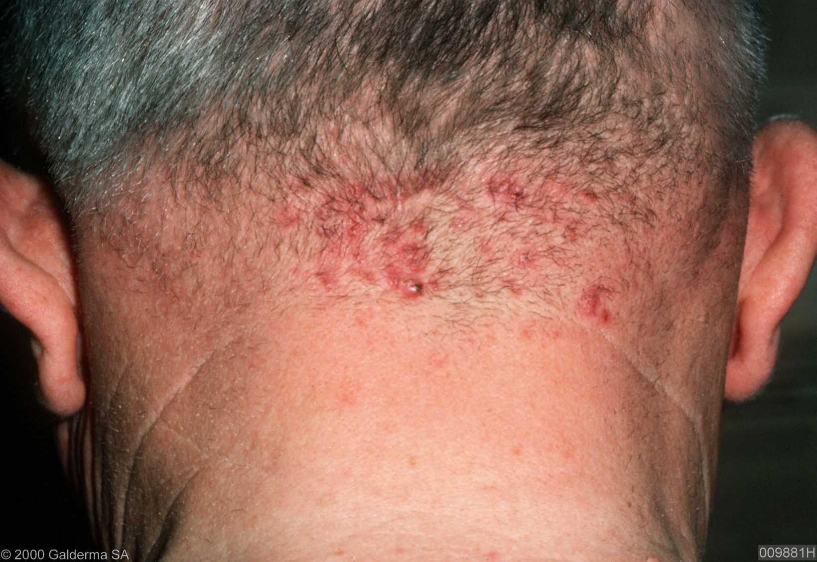 Occurrence of acne keloidalis and folliculitis decalvans 