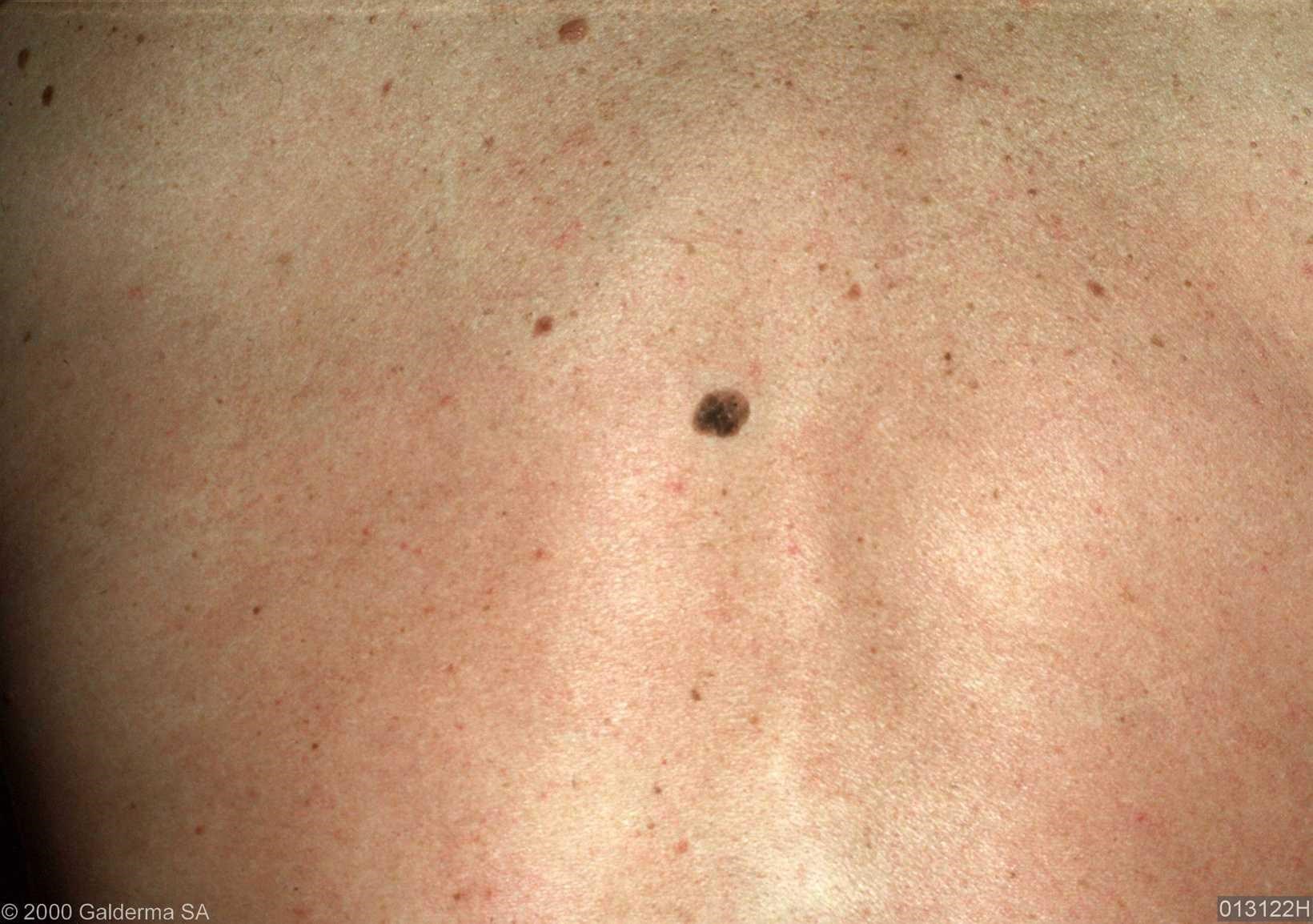 keratosis