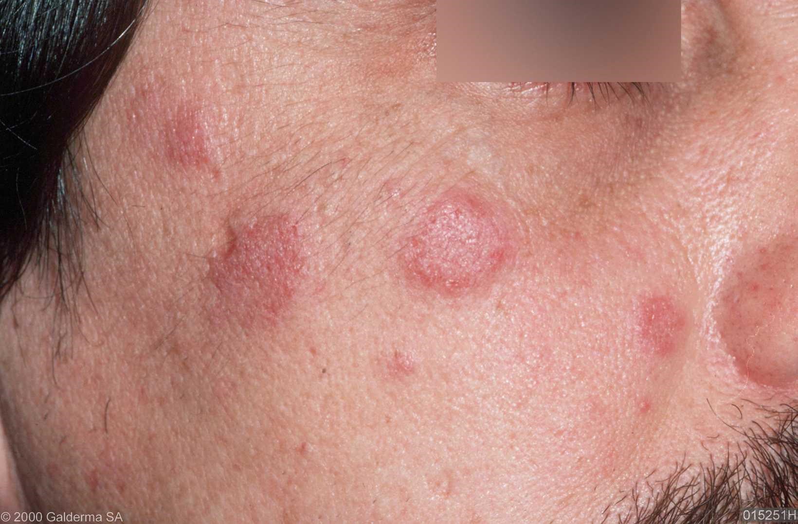 discoid-lupus-erythematosus-like-lesions-and-stomatitis-dermatology