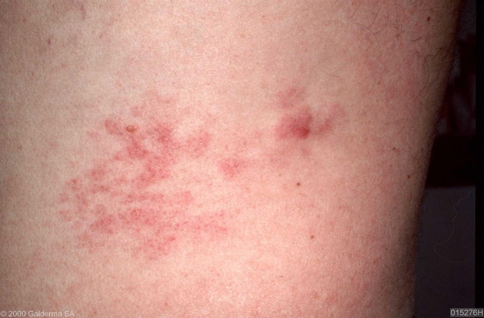 what-does-a-lymphoma-skin-rash-look-like-stages-amp-treatment-riset