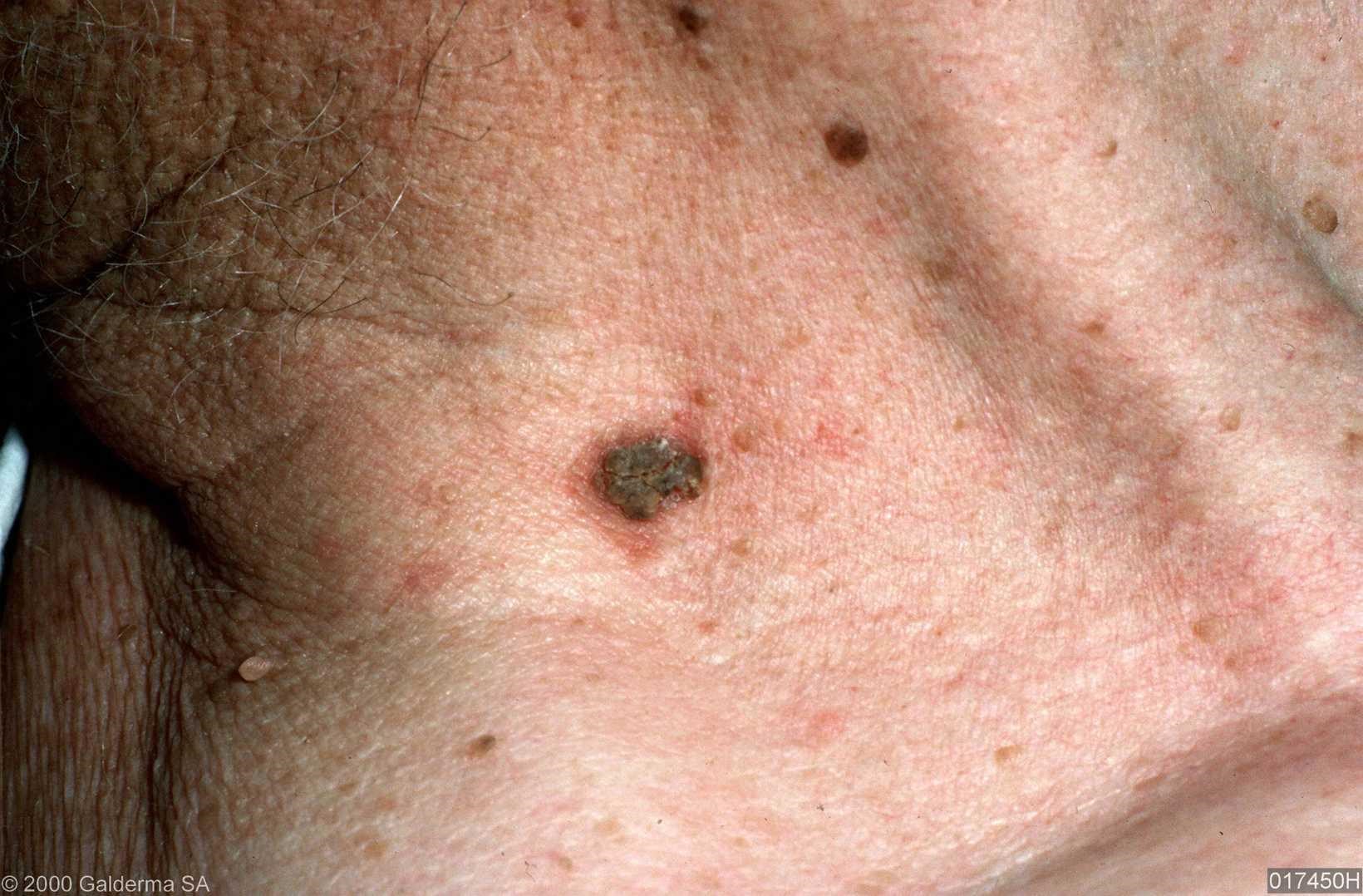 solar keratosis pictures - pictures, photos