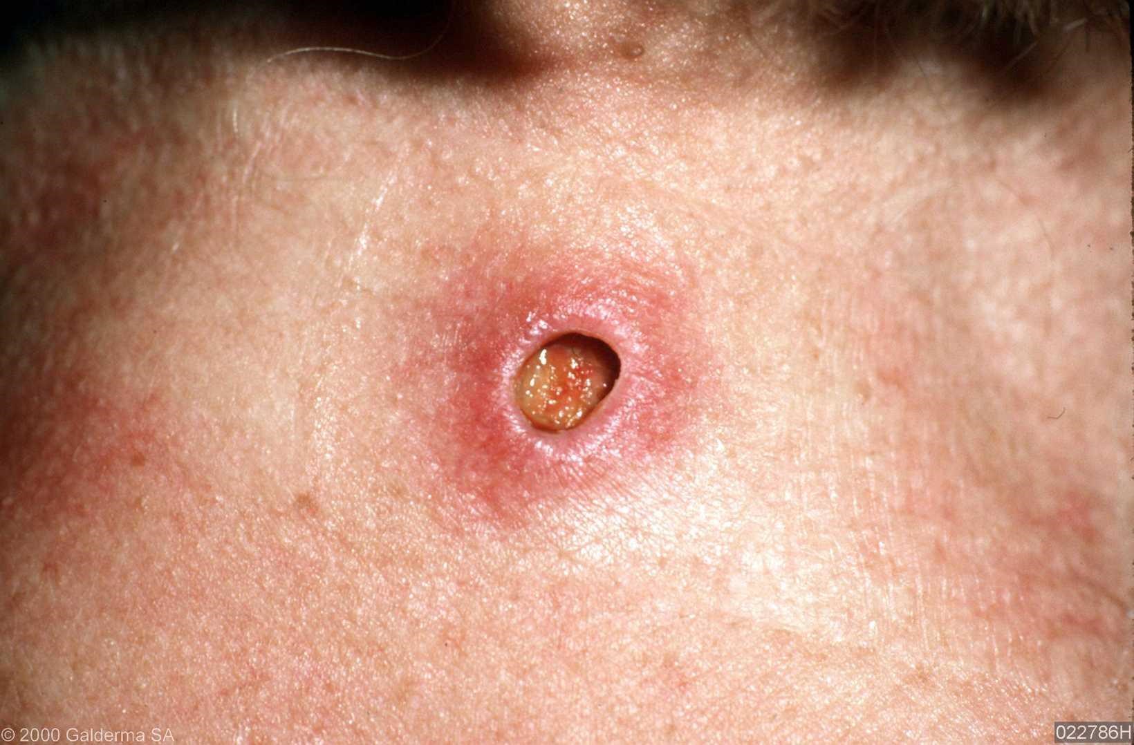 фурункул на груди у женщин лечение фото 86