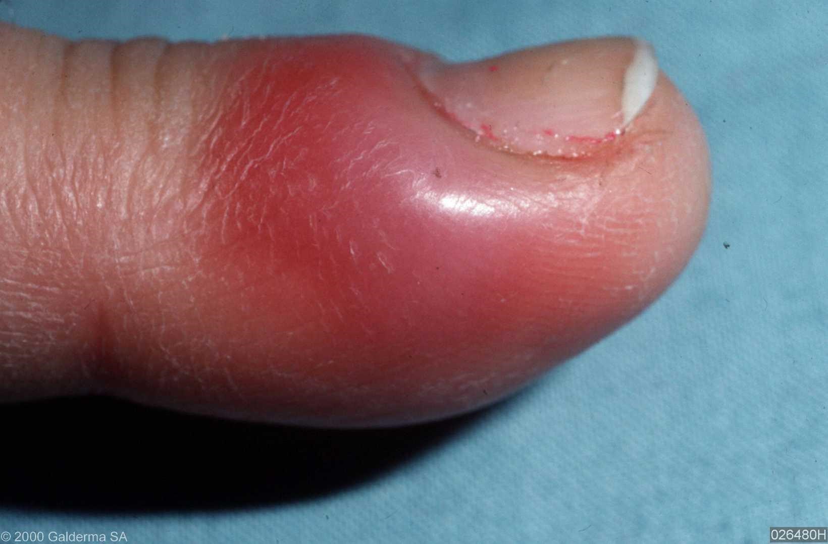 paronychia-causes-and-treatment-of-an-infected-nail