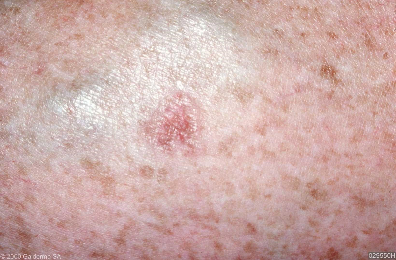 disseminated superficial actinic porokeratosis - pictures, photos