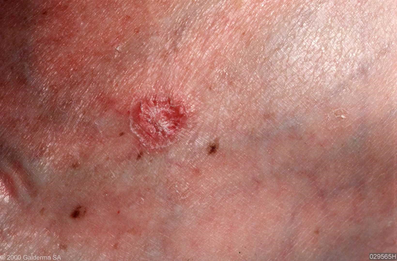 actinic porokeratosis - pictures, photos