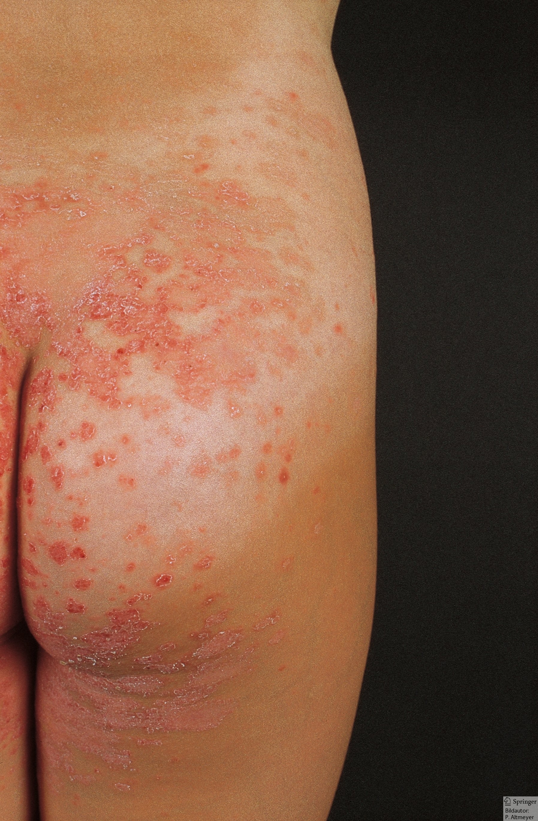 pityriasis rosea herpes - pictures, photos