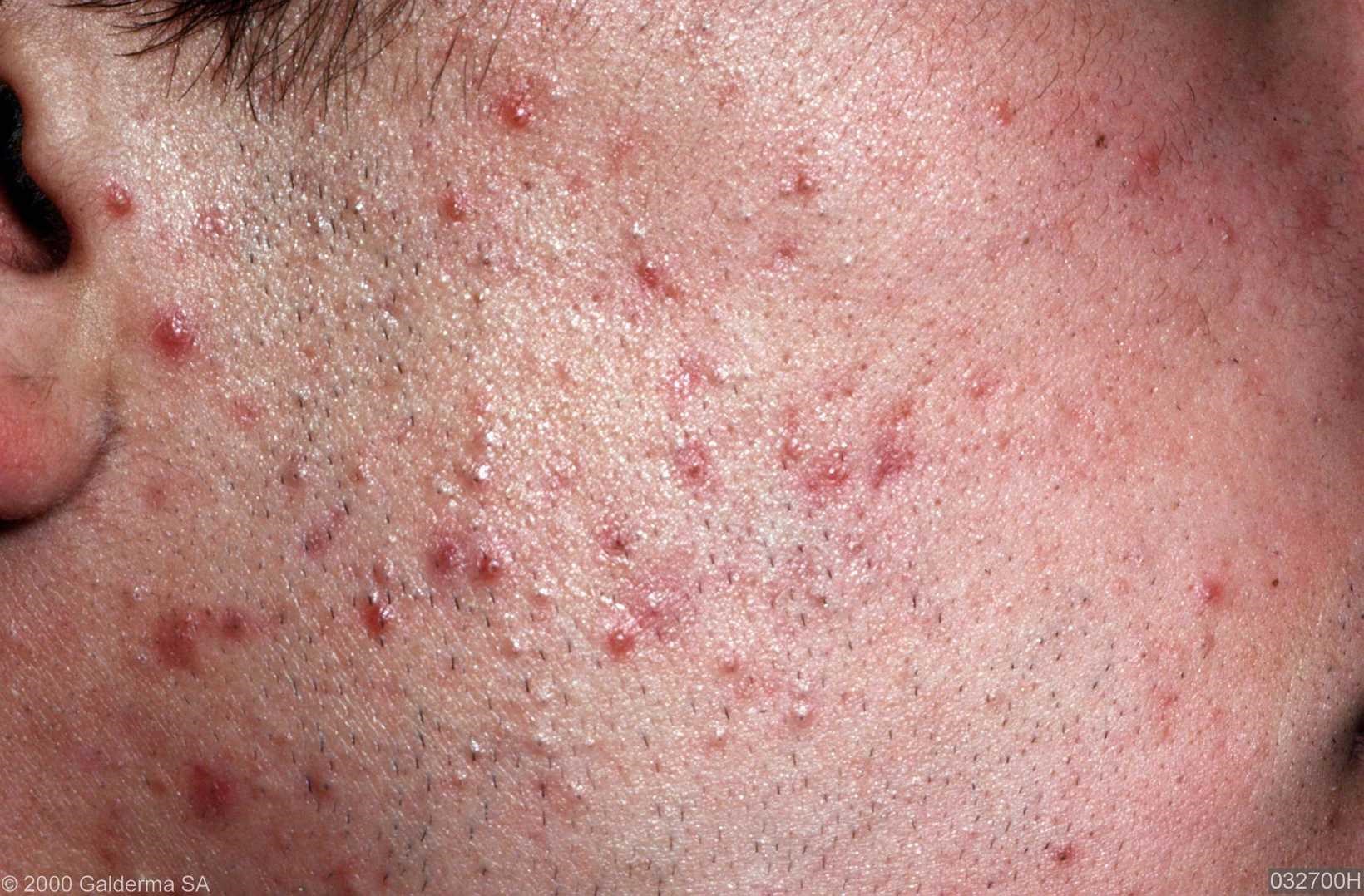 acne-vulgaris-pictures-photos