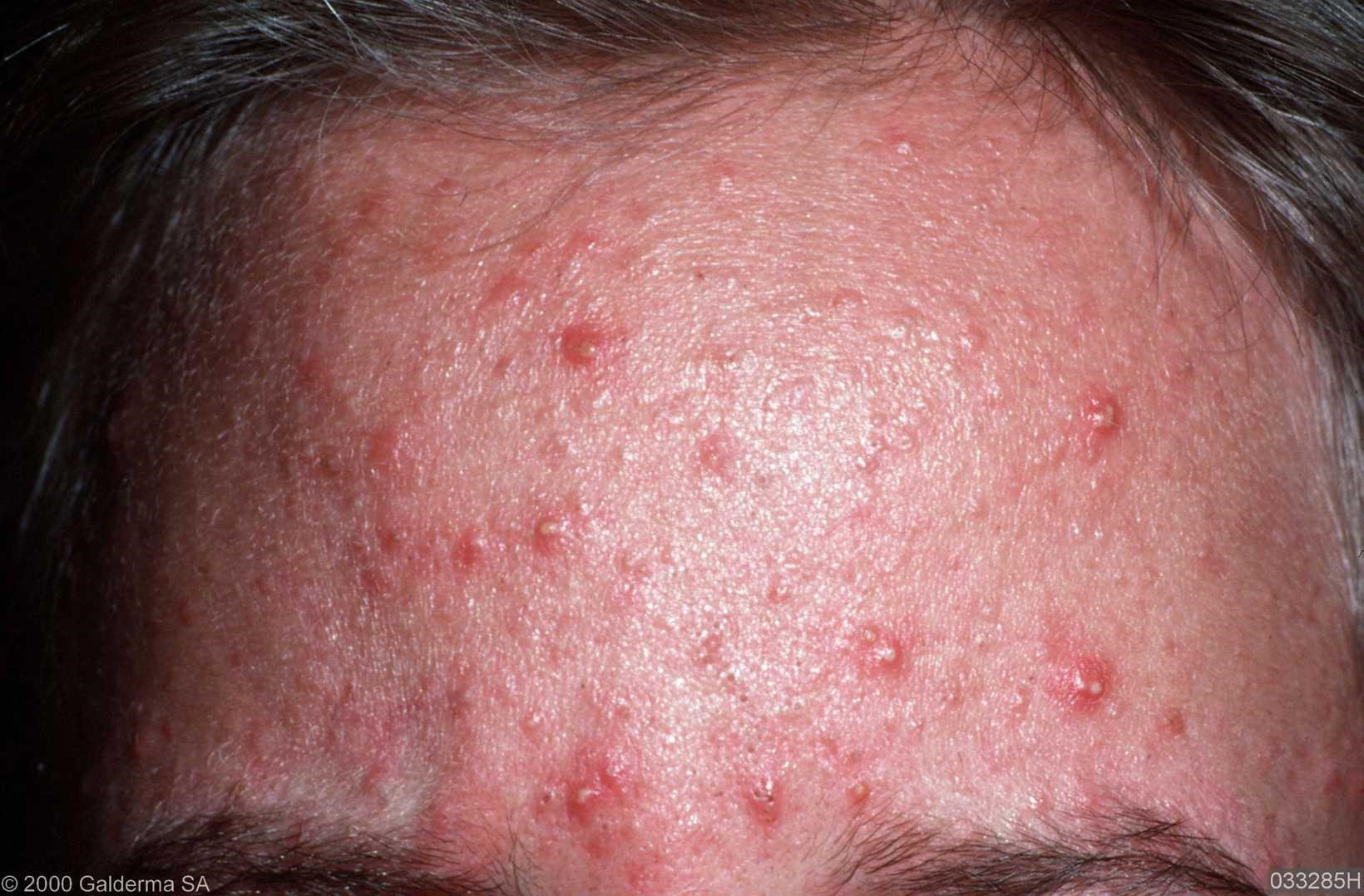 Folliculitis On Face Pictures Photos