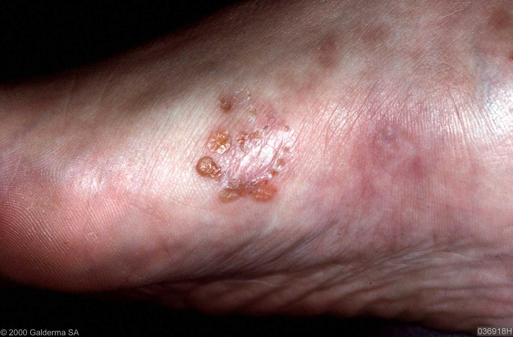 vesicular-tinea-pedis-pictures-photos