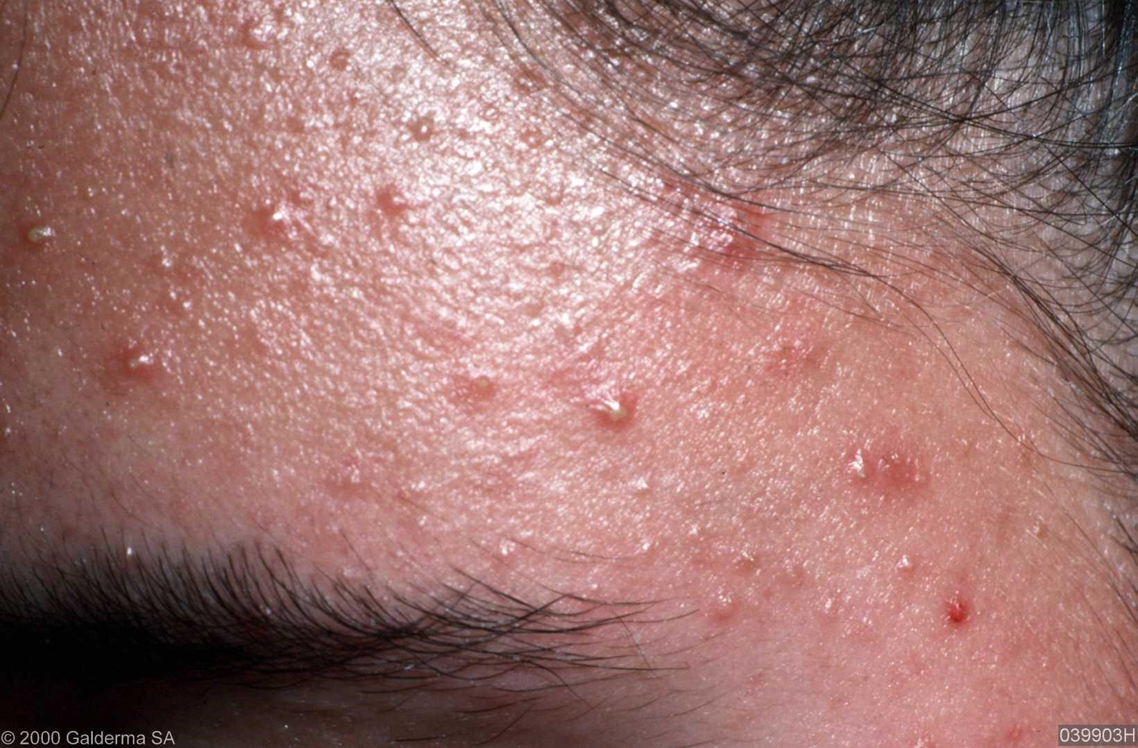 Pityrosporum Folliculitis Treatment Pictures Photos