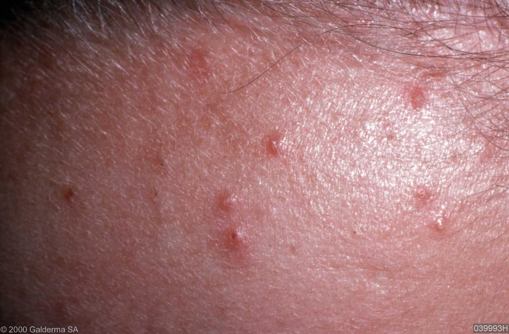 Pityriasis Folliculitis 