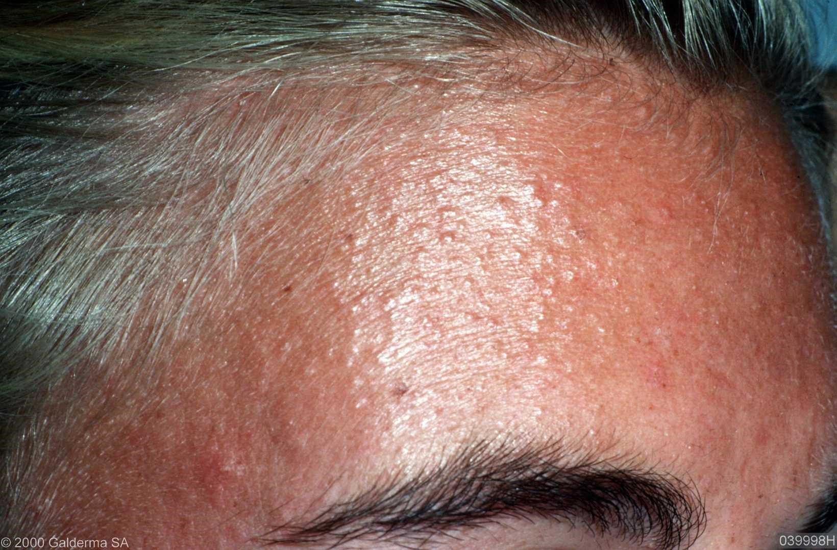 Folliculitis Fungal Scalp