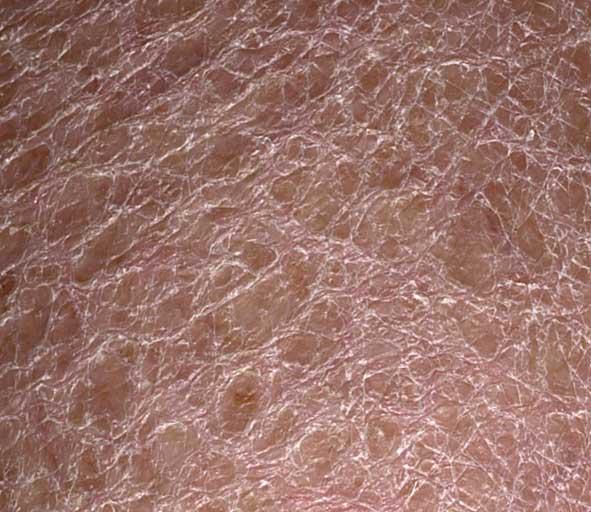 Scaly Skin  Ichthyosis Vulgaris - Skinsight