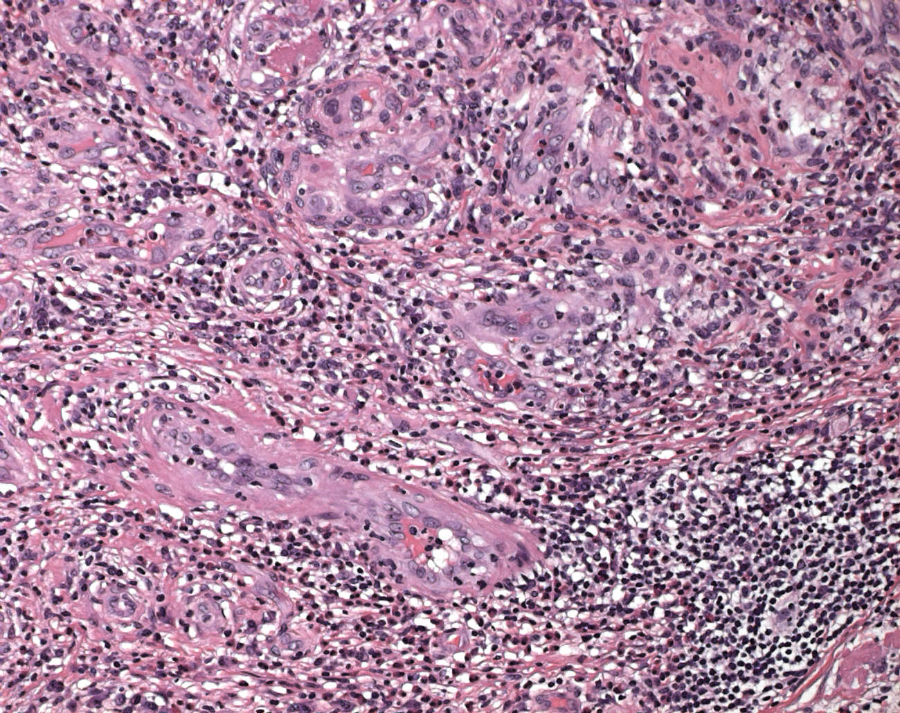 cutaneous lymphoid hyperplasia icd 10