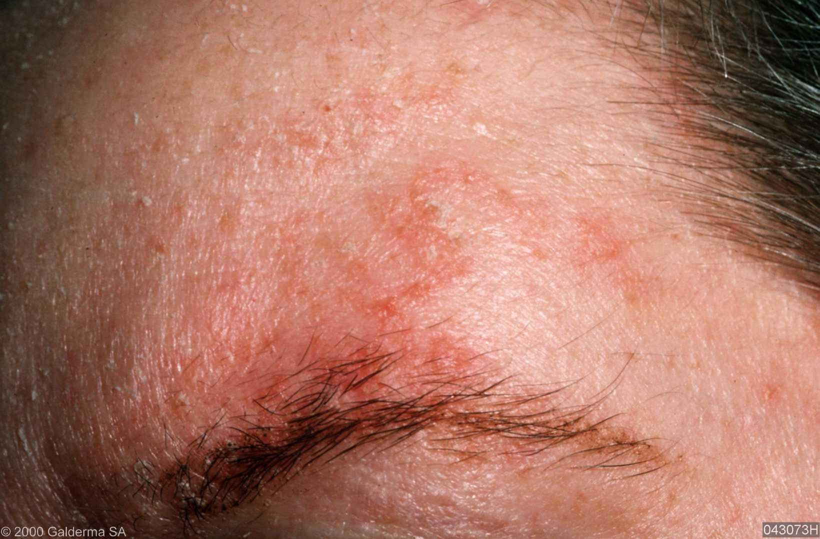 dry rash on face - pictures, photos