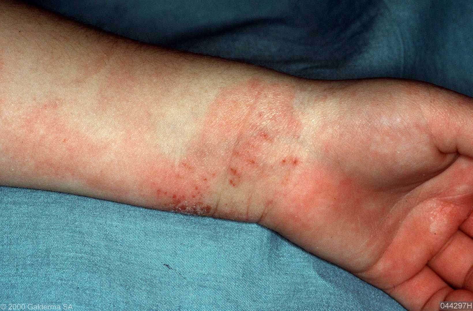 Skin Rash On Elbow Pictures Photos