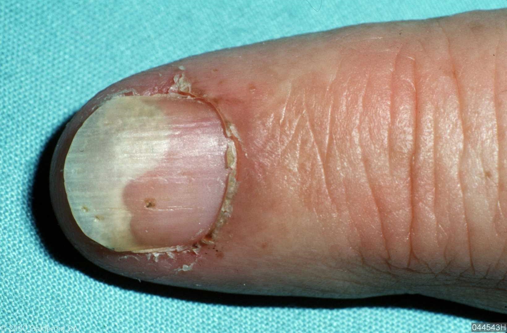 nail psoriasis pictures pictures, photos