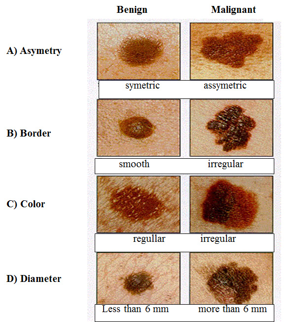 melanoma in children - pictures, photos