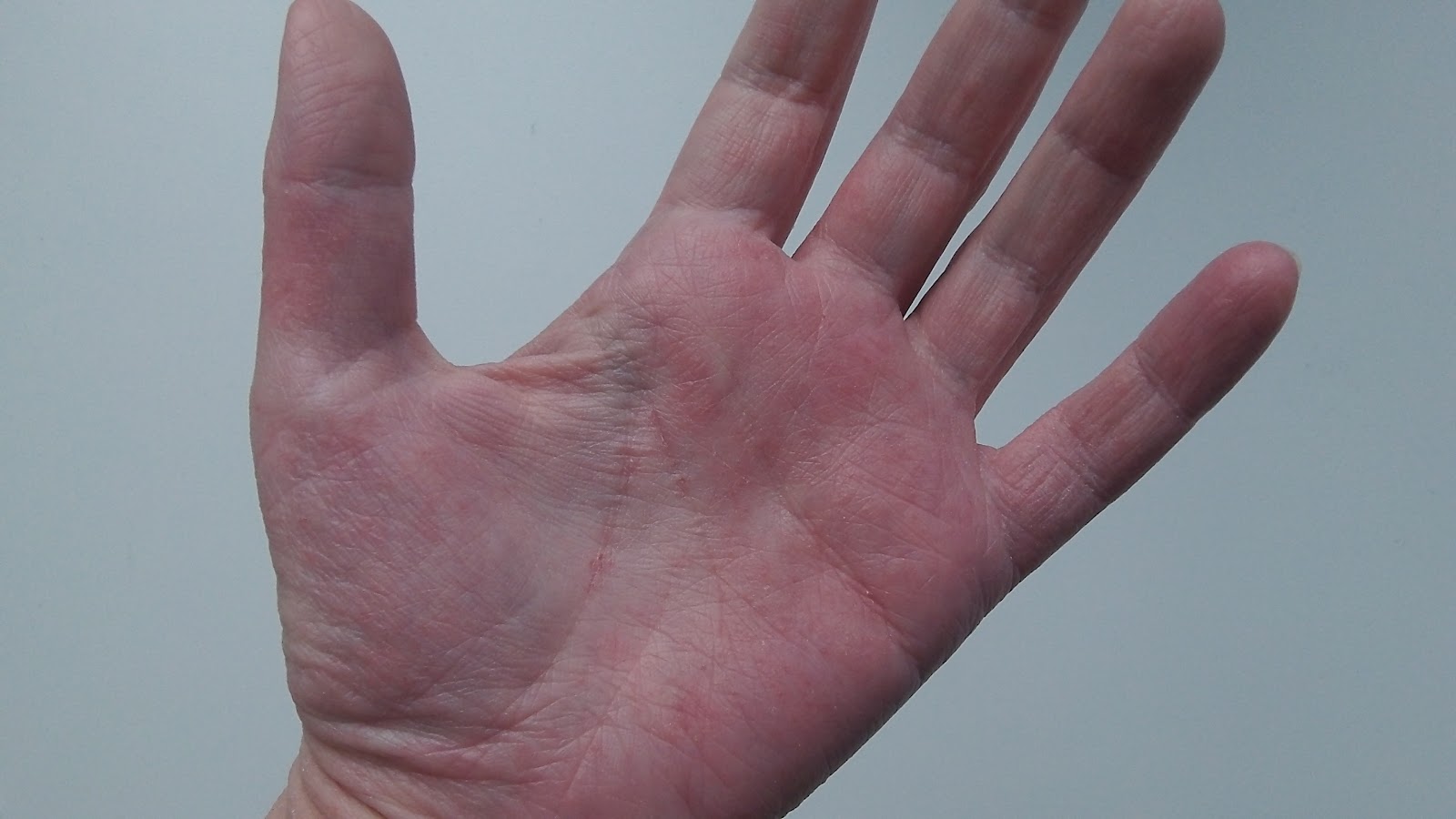 Itchy Red Bumps Under Skin On Palms Of Hands