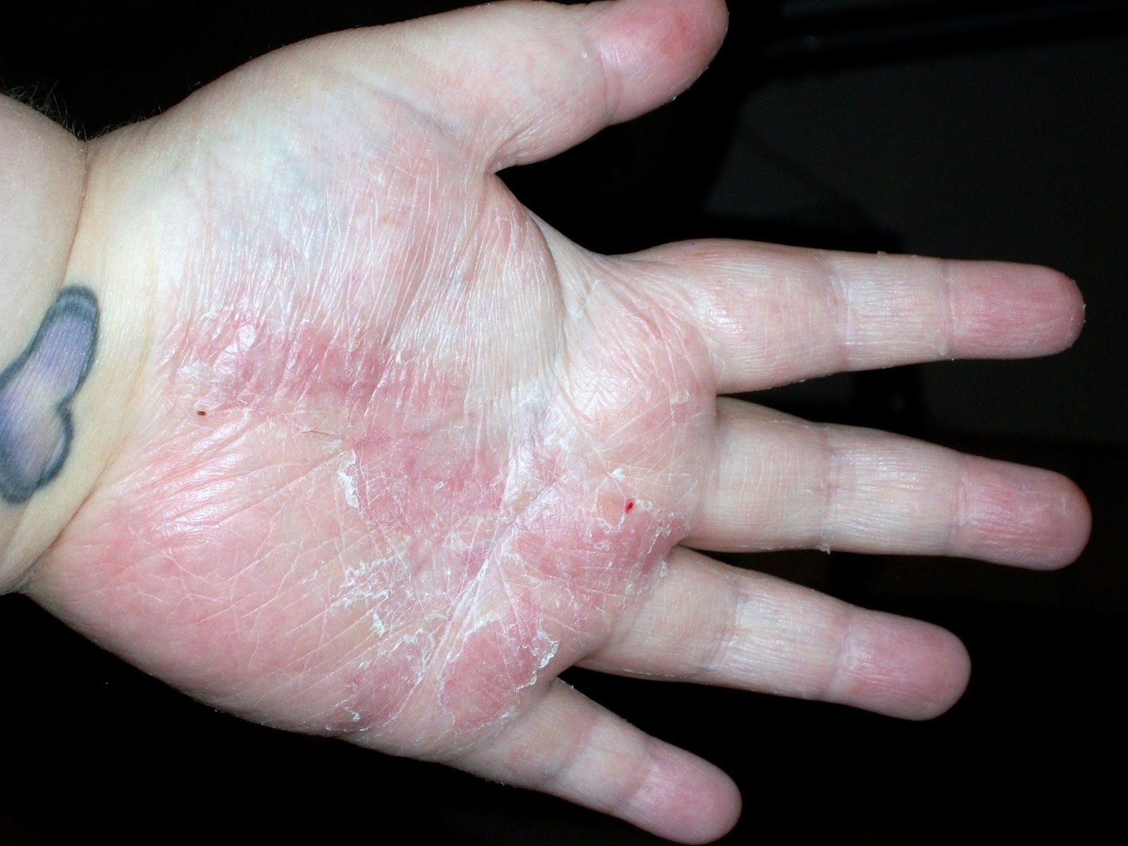 Psoriasis Rash Pictures Symptoms