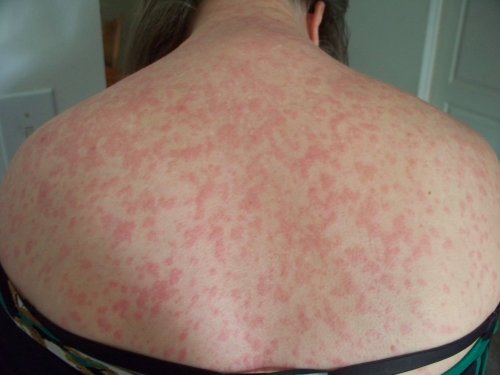 serious skin rashes that itch