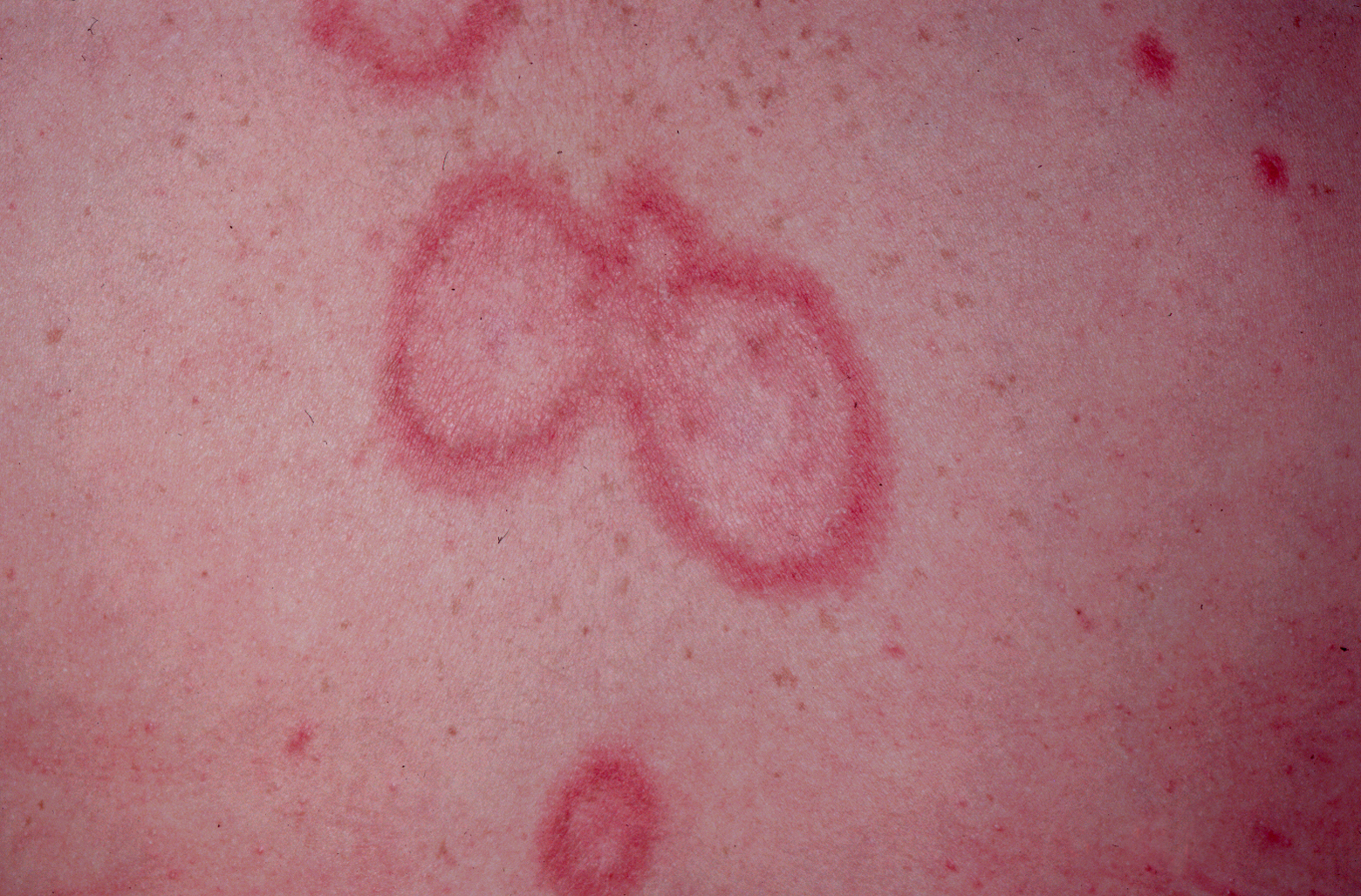 acute-cutaneous-lupus-pictures-photos