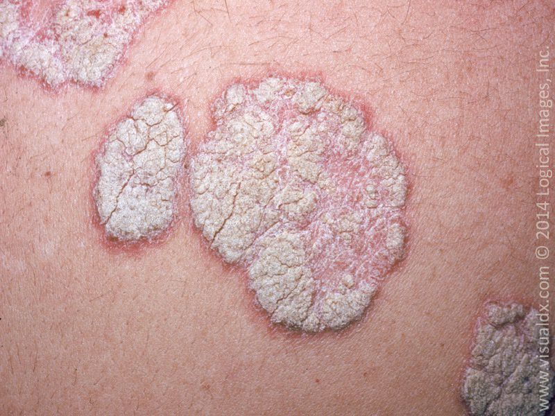 brown-scaly-spots-on-skin