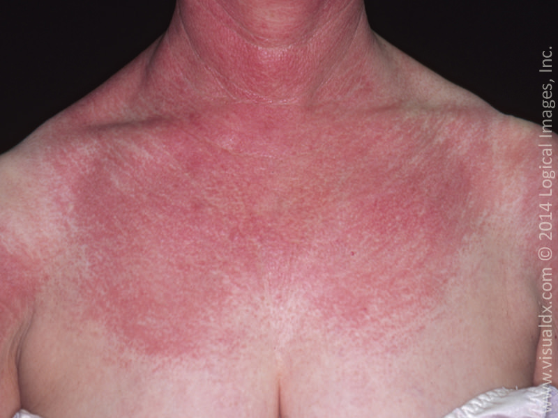 redness on chest - pictures, photos