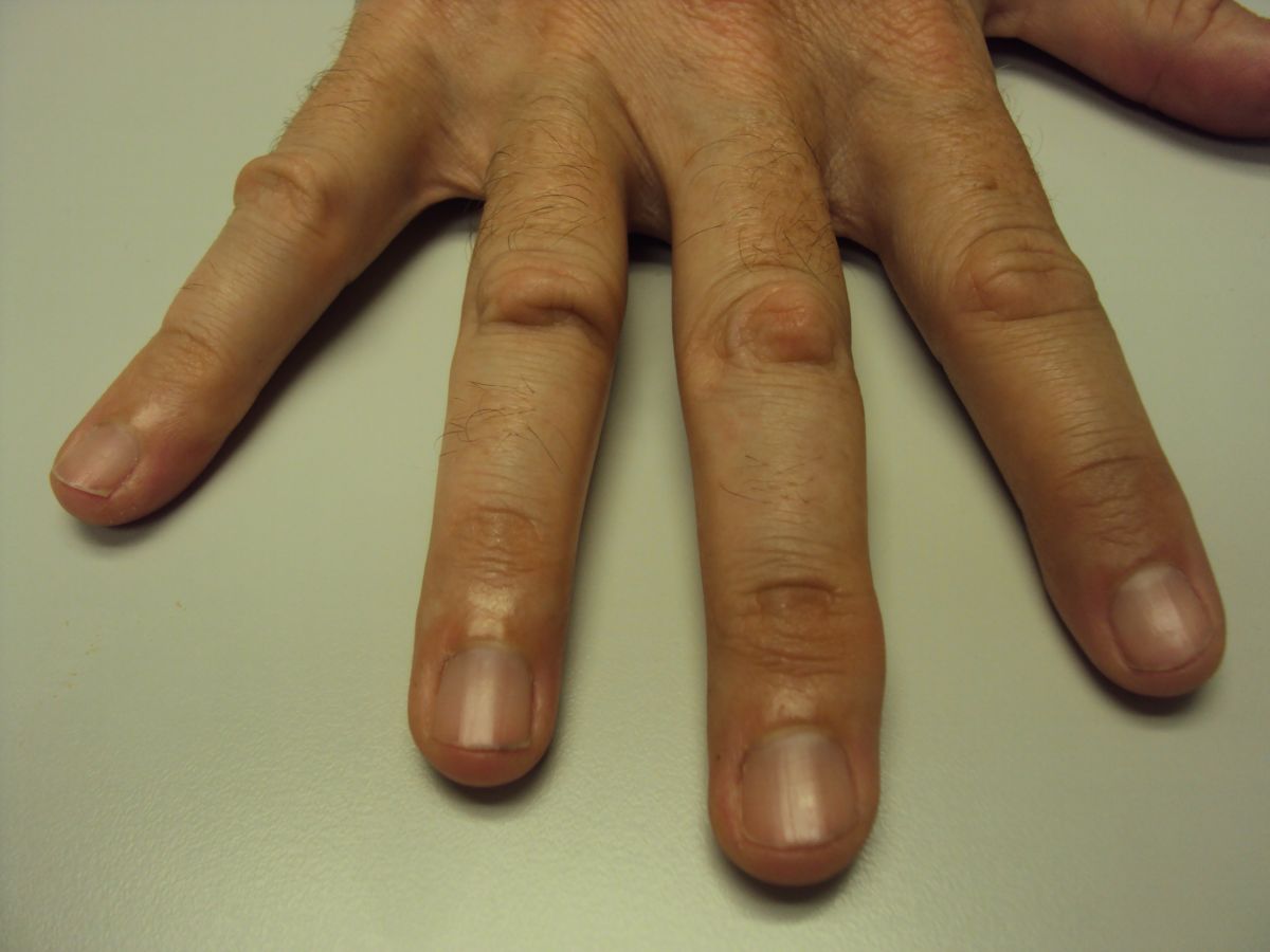 knuckle-calluses-pictures-photos