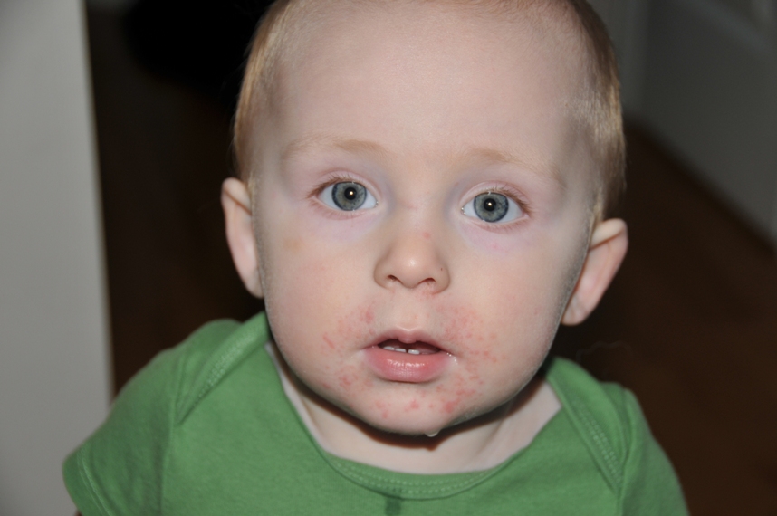 Red Rash Around Mouth Toddler