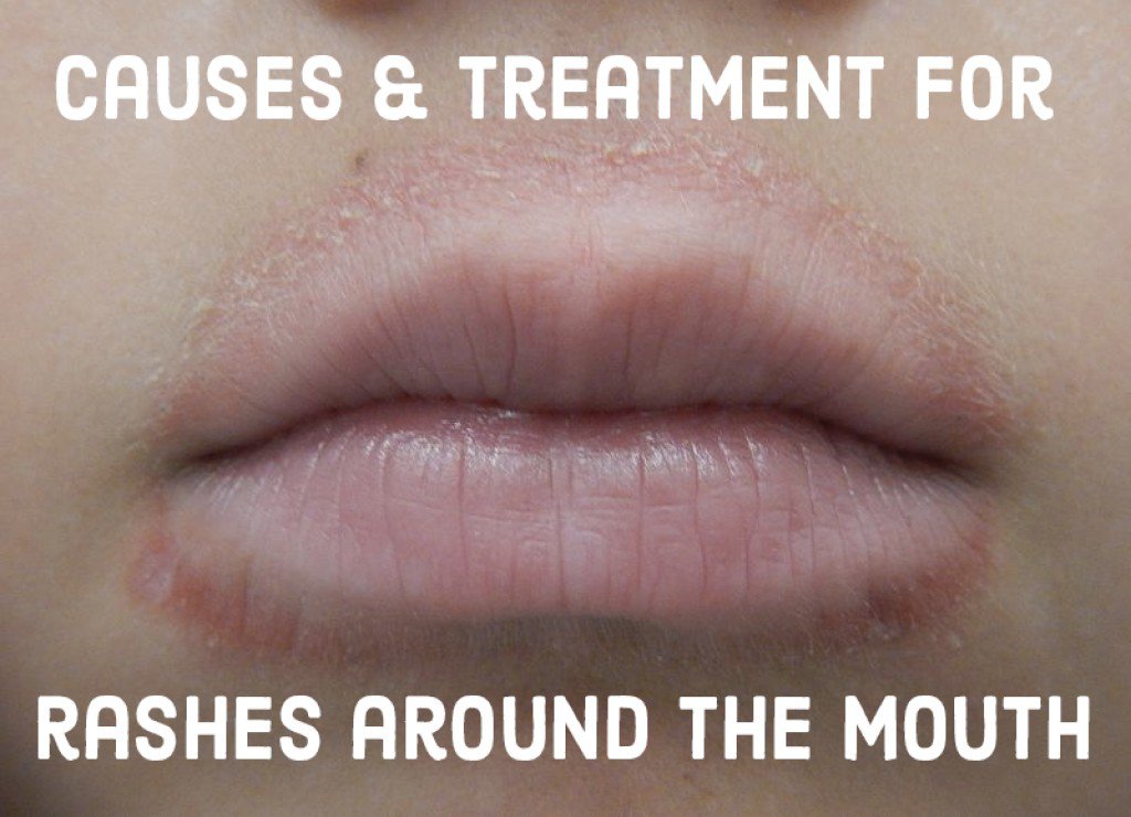 rash around mouth children - pictures, photos