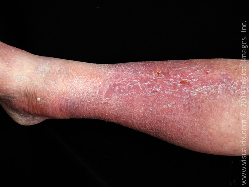 Stasis Dermatitis Eczema On Legs Causes Treatment Sta Vrogue Co