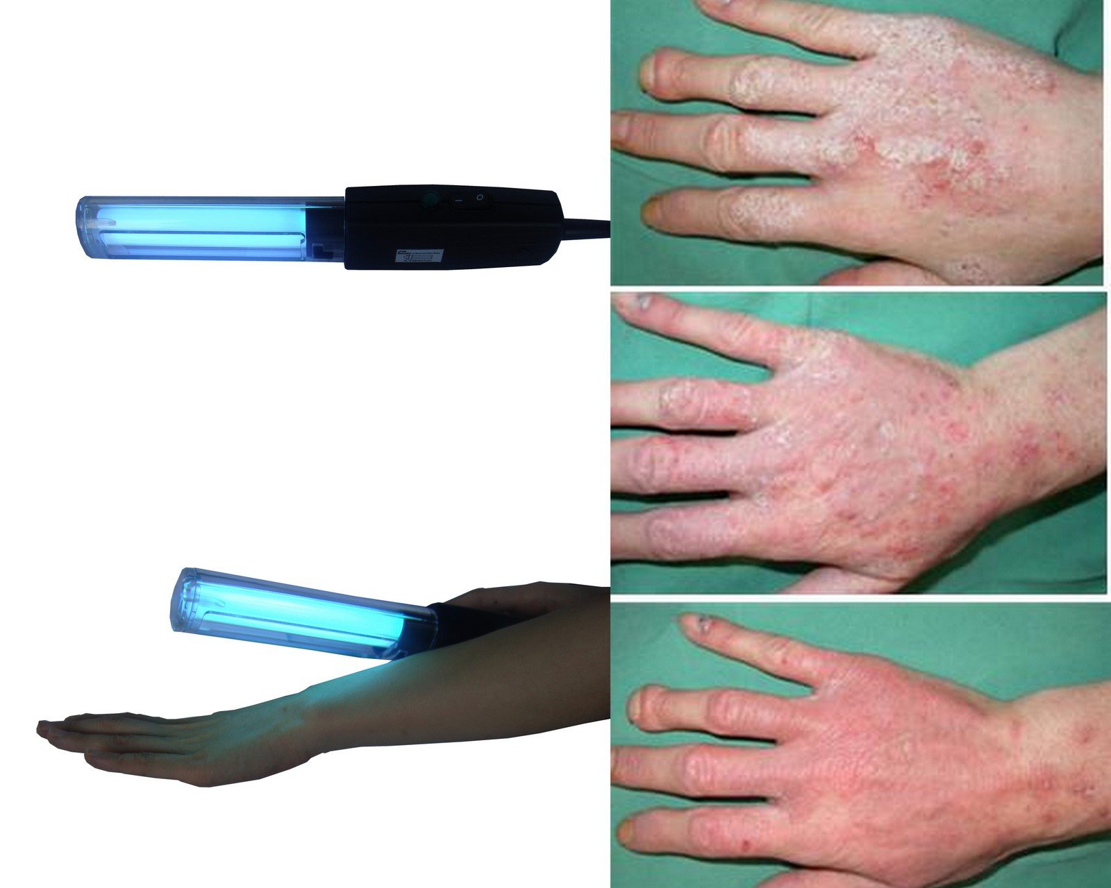 Uvb Light Therapy Pictures Photos