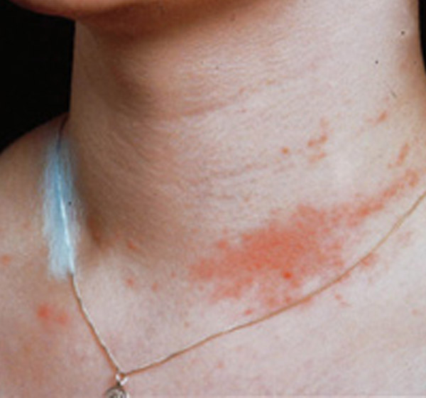 nickel-allergies-pictures-photos