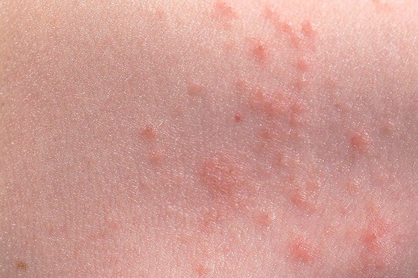 rash on child - pictures, photos