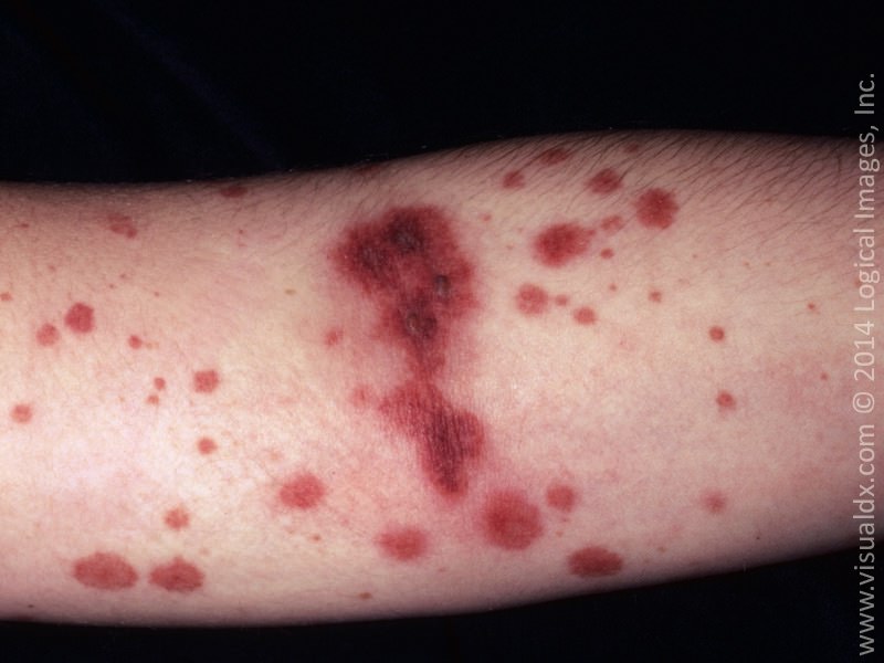 vasculitis images - pictures, photos