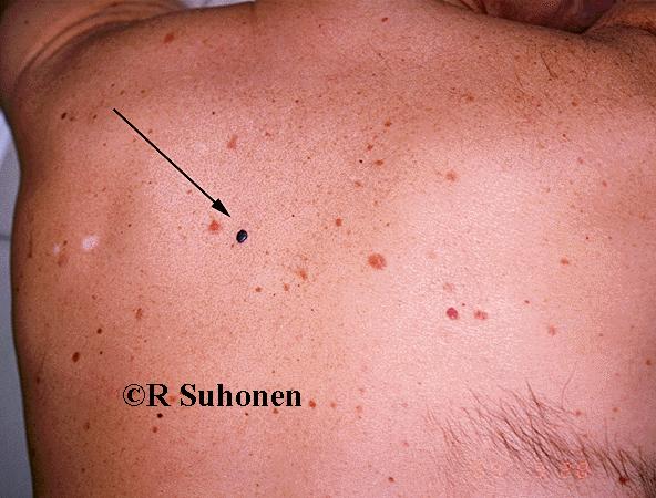 Melanoma Skin Cancer On Back