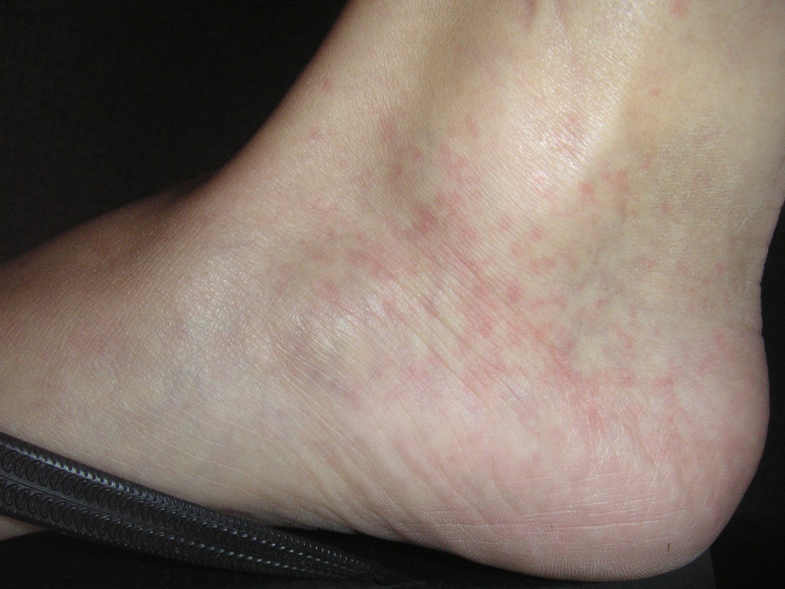 red-spots-on-ankles-pictures-photos