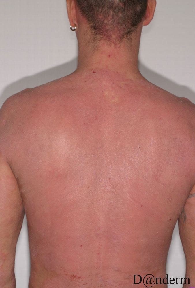 dermatitis photos - pictures, photos