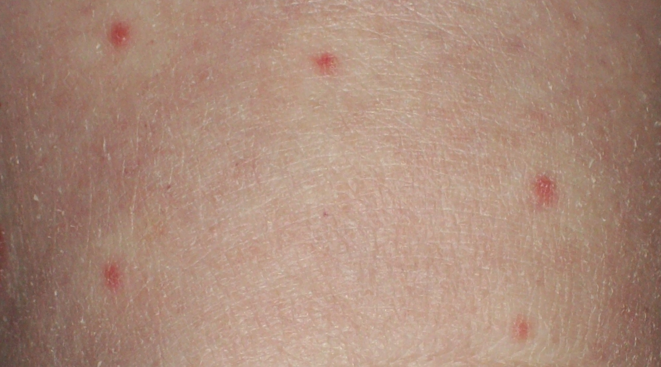 Red Spots On Skin Not Itchy