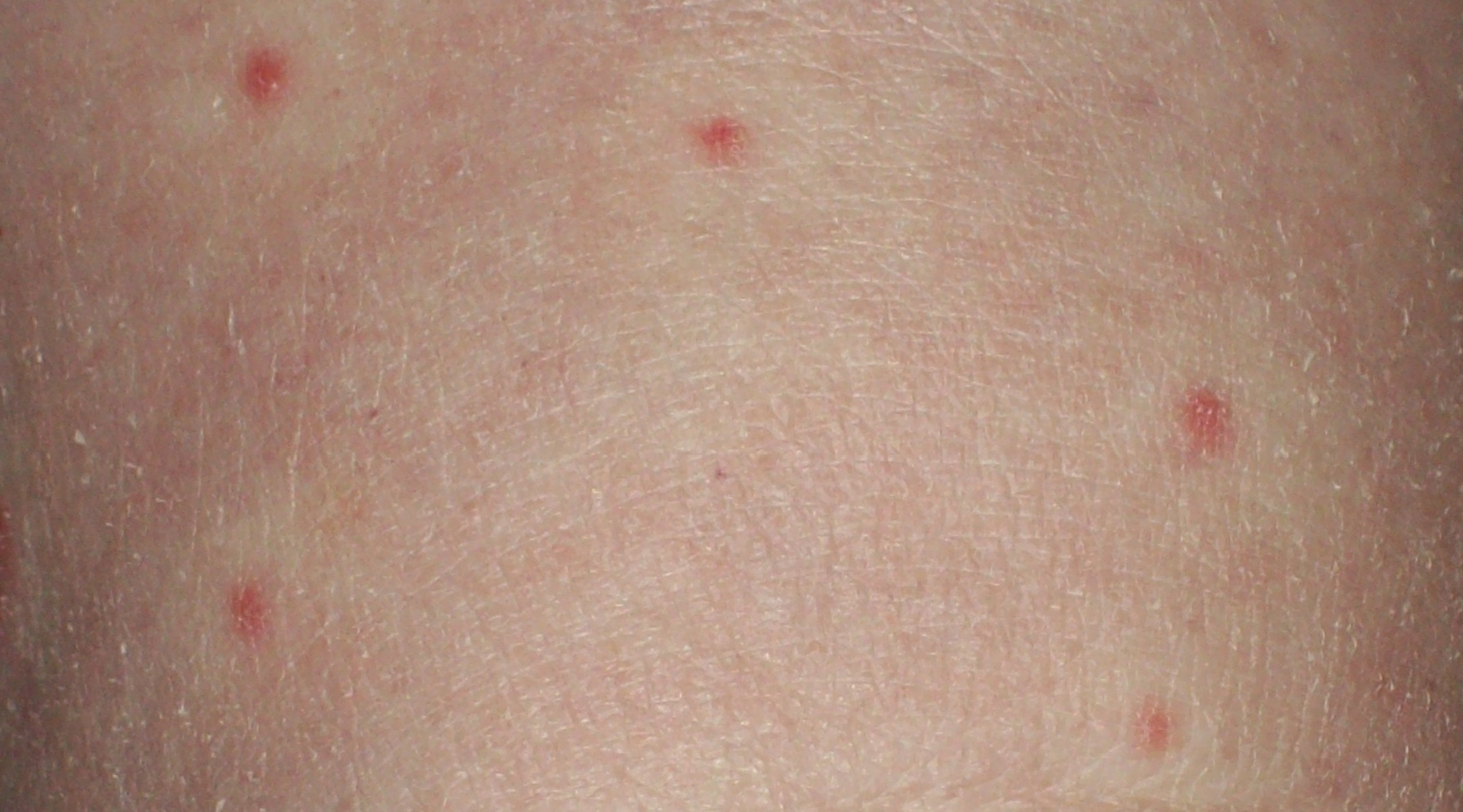 Keith Greer Buzz Red spots on skin not itchy