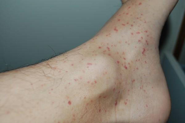 red-spots-on-legs-feet-dots-patches-not-itchy-pictures-causes